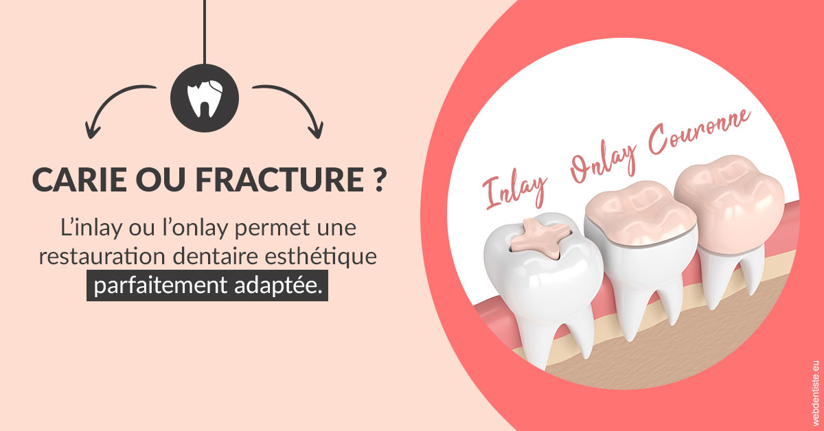https://www.dentiste-pierre-bertrand-liege-jemeppe.be/T2 2023 - Carie ou fracture 2