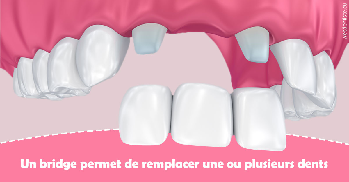 https://www.dentiste-pierre-bertrand-liege-jemeppe.be/Bridge remplacer dents 2