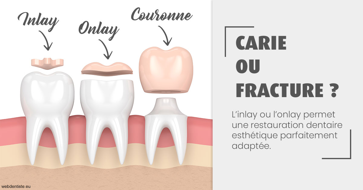 https://www.dentiste-pierre-bertrand-liege-jemeppe.be/T2 2023 - Carie ou fracture 1