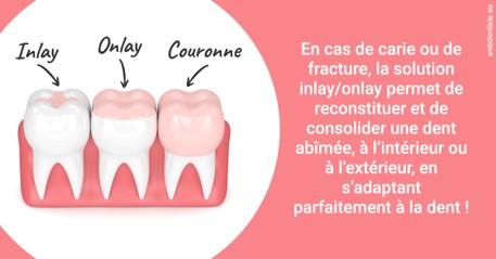 https://www.dentiste-pierre-bertrand-liege-jemeppe.be/L'INLAY ou l'ONLAY 2