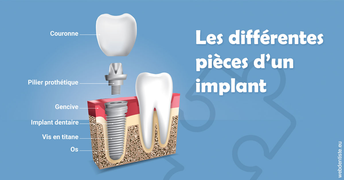 https://www.dentiste-pierre-bertrand-liege-jemeppe.be/Les différentes pièces d’un implant 1